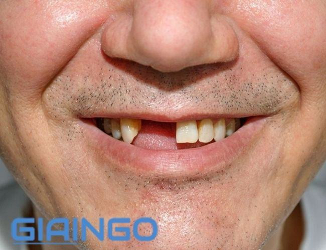 Mơ thấy rụng răng