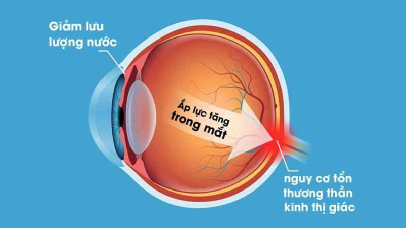 Tăng nhãn áp là gì?