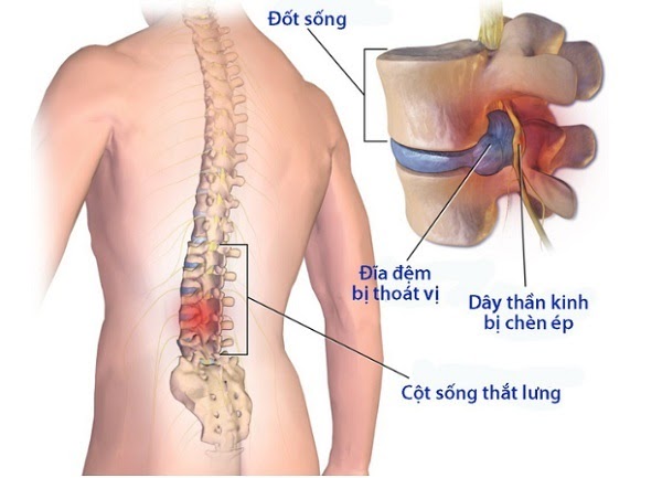 nguyên nhân đau thắt lưng