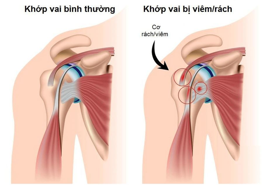 cách chữa trị trật khớp vai