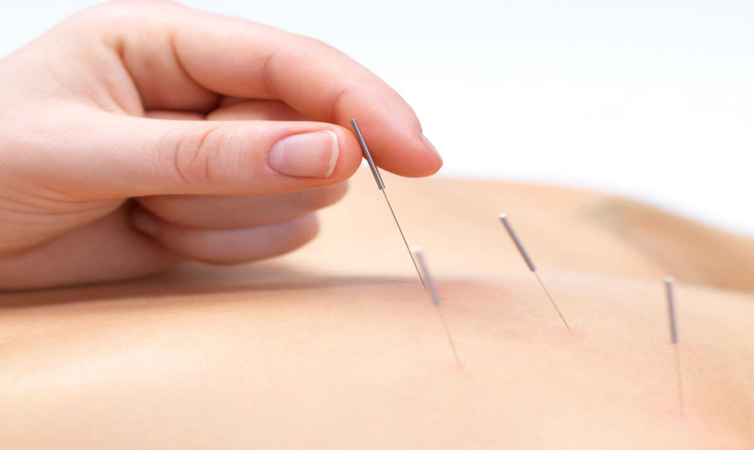 Làm ngày đèn đỏ nhanh hết bằng cách châm cứu