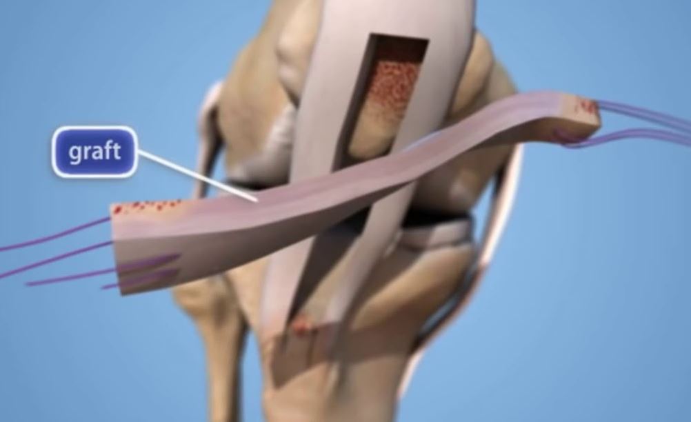 phẫu thuật đứt dây chằng chéo trước