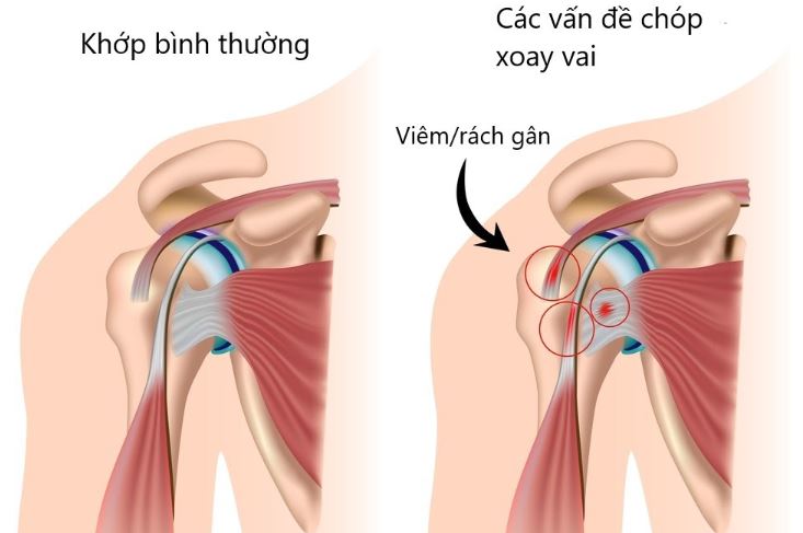 đau khớp vai do đâu