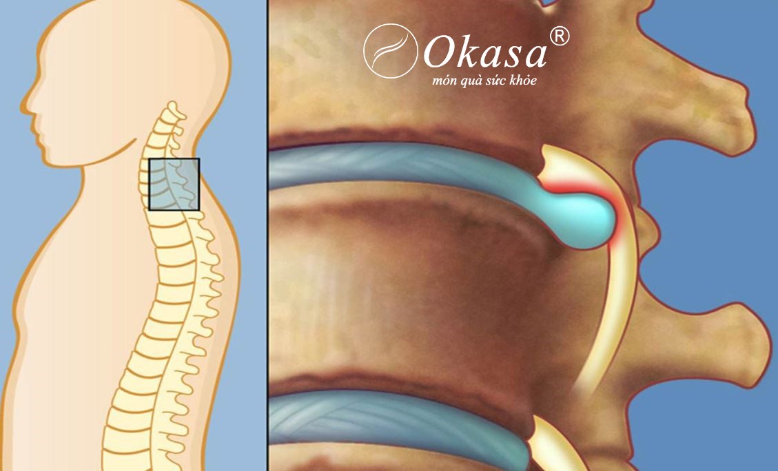 điều trị thoát vị đĩa đệm cổ