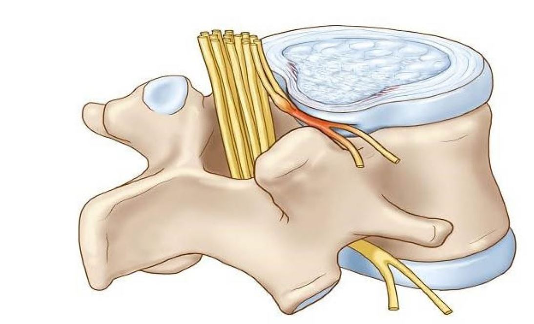 Thoát vị đĩa đệm cổ cần lưu ý những gì