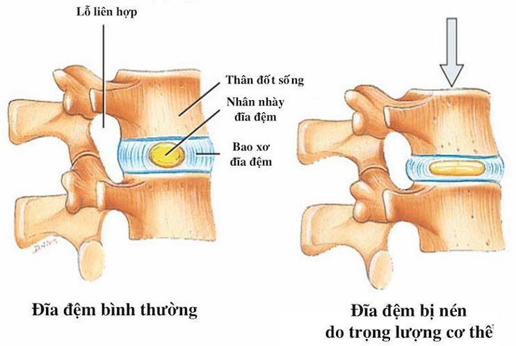 tình trạng xẹp đĩa đệm