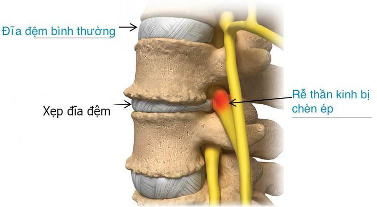 xẹp đĩa đệm là gì