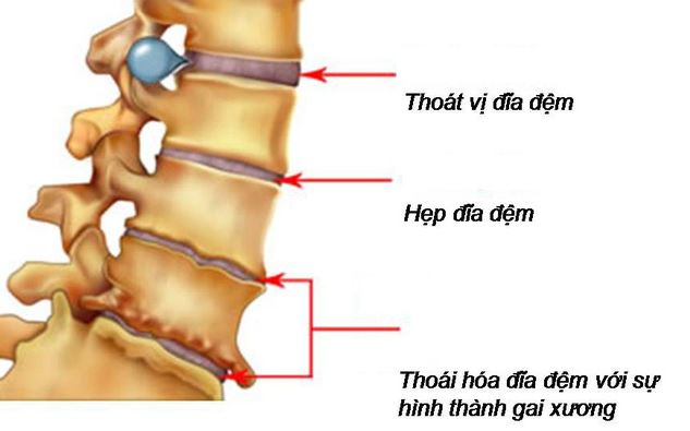 xẹp đĩa đệm